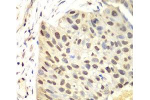 Immunohistochemistry of paraffin-embedded Human lung cancer using FEN1 Polyclonal Antibody at dilution of 1:100 (40x lens). (FEN1 抗体)