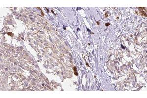 ABIN6279821 at 1/100 staining Human Melanoma tissue by IHC-P. (CCL1 抗体  (Internal Region))