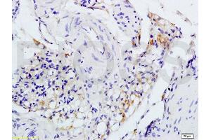 Formalin-fixed and paraffin embedded rat colitis tissue labeled with Anti-IL-1R1 CD121a IL1 Receptor I Polyclonal Antibody, unconjugated (ABIN747743) at 1:200 followed by incubation with conjugated secondary antibody and DAB staining