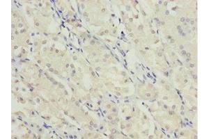 Immunohistochemistry of paraffin-embedded human gastric cancer using ABIN7174959 at dilution of 1:100 (MYO5C 抗体  (AA 270-420))