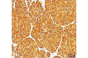IHC staining of melanoma tissue (10X) with Tyrosinase antibody (T311).