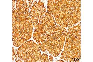 IHC staining of melanoma tissue (10X) with Tyrosinase antibody (T311). (TYR 抗体)