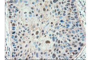 Immunohistochemical staining of paraffin-embedded Adenocarcinoma of colon using anti-PTCH1 (ABIN2452537) mouse monoclonal antibody. (Patched 1 抗体  (AA 122-436))