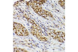 Immunohistochemistry of paraffin-embedded human breast cancer using COX2/PTGS2 Rabbit pAb (ABIN6130125, ABIN6146415, ABIN6146417 and ABIN6216190) at dilution of 1:50 (40x lens).