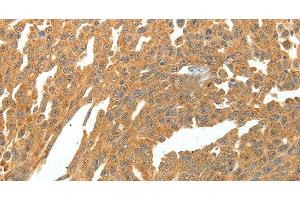 Immunohistochemistry of paraffin-embedded Human ovarian cancer using SKP1 Polyclonal Antibody at dilution of 1:30 (SKP1 抗体)