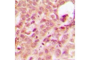 Immunohistochemical analysis of ABL1 staining in human breast cancer formalin fixed paraffin embedded tissue section. (ABL1 抗体  (N-Term))