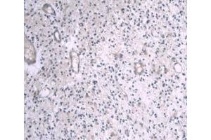 IHC-P analysis of Human Glioma Tissue, with DAB staining. (APOA1 抗体  (AA 122-267))