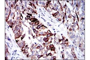Immunohistochemical analysis of paraffin-embedded bladder cancer tissues using CK5 mouse mAb with DAB staining. (Cytokeratin 5 抗体  (AA 316-590))