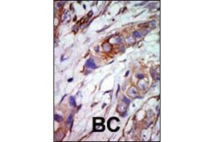 Formalin-fixed and paraffin-embedded human cancer tissue reacted with the primary antibody, which was peroxidase-conjugated to the secondary antibody, followed by AEC staining. (MAPK7 抗体  (C-Term))