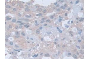 Detection of RARa in Human Breast cancer Tissue using Polyclonal Antibody to Retinoic Acid Receptor Alpha (RARa) (Retinoic Acid Receptor alpha 抗体  (AA 68-173))