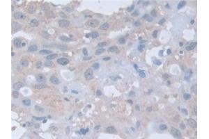 Detection of RARa in Human Breast cancer Tissue using Polyclonal Antibody to Retinoic Acid Receptor Alpha (RARa)