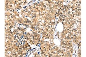 The image on the left is immunohistochemistry of paraffin-embedded Human breast cancer tissue using ABIN7192874(TPR Antibody) at dilution 1/20, on the right is treated with synthetic peptide. (TPR 抗体)