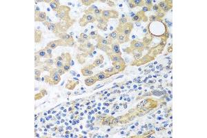 Immunohistochemistry of paraffin-embedded human liver cancer using GLUD1 antibody. (GLUD1 抗体  (AA 54-240))