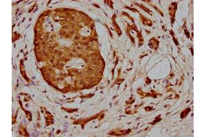 IHC image of ABIN7160033 diluted at 1:400 and staining in paraffin-embedded human pancreatic cancer performed on a Leica BondTM system. (MAP3K2 抗体  (AA 357-619))