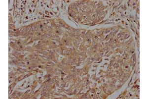 IHC image of ABIN7156340 diluted at 1:200 and staining in paraffin-embedded human cervical cancer performed on a Leica BondTM system. (INSRR 抗体  (AA 747-921))