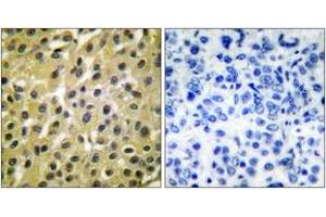 Immunohistochemistry analysis of paraffin-embedded human breast carcinoma tissue, using MDM2 Antibody. (MDM2 抗体  (AA 391-440))