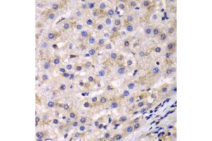 Immunohistochemistry of paraffin-embedded human liver cancer using EEF2 antibody at dilution of 1:100 (400x lens). (EEF2 抗体)