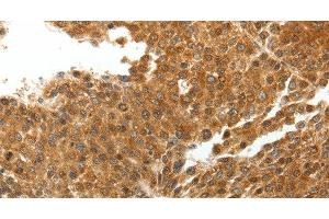 Immunohistochemistry of paraffin-embedded Human liver cancer tissue using TNXB Polyclonal Antibody at dilution 1:40 (TNXB 抗体)