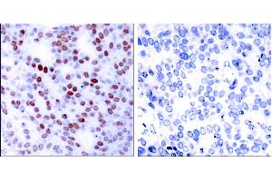 Peptide - +Immunohistochemical analysis of paraffin-embedded human breast carcinoma tissue using c-Jun (Ab-243) antibody (#B7130). (C-JUN 抗体  (Ser243))