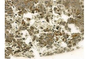 ABIN6256633 and ABIN6267212 at 1/100 staining human melanoma by IHC-P.