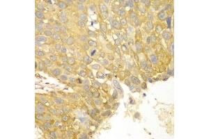 Immunohistochemistry of paraffin-embedded human lung cancer using ACTN1 antibody. (ACTN1 抗体  (AA 1-330))