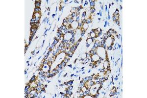 Immunohistochemistry of paraffin-embedded human colon carcinoma using STAT3 antibody (ABIN6293492) at dilution of 1:100 (40x lens). (STAT3 抗体)