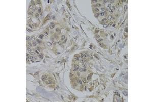 Immunohistochemistry of paraffin-embedded human breast cancer using AKT1S1 Antibody (ABIN5973672) at dilution of 1/100 (40x lens). (PRAS40 抗体)