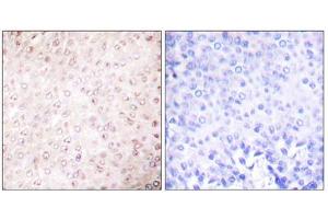 Immunohistochemical analysis of paraffin-embedded human breast carcinoma tissue using P300/CBP Antibody (ABIN5976479). (CBP 抗体  (C-Term))