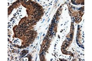 Immunohistochemical staining of paraffin-embedded liver tissue using anti-L1CAM mouse monoclonal antibody. (L1CAM 抗体)