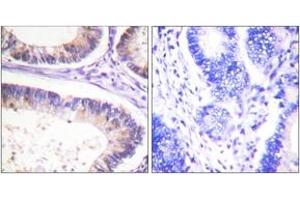 Immunohistochemistry analysis of paraffin-embedded human colon carcinoma, using CBL (Phospho-Tyr674) Antibody. (CBL 抗体  (pTyr674))