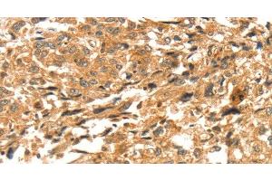 Immunohistochemistry of paraffin-embedded Human esophagus cancer tissue using DIRAS1 Polyclonal Antibody at dilution 1:52 (DIRAS1 抗体)