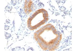 Formalin-fixed, paraffin-embedded human Melanoma stained with CD86 Mouse Monoclonal Antibody (C86/1146). (CD86 抗体)