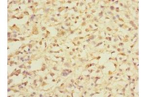 Immunohistochemistry of paraffin-embedded human melanoma using ABIN7164368 at dilution of 1:100 (DDX59 抗体  (AA 1-200))