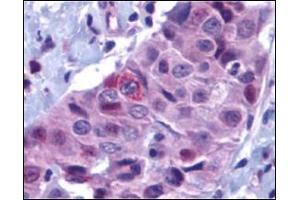 Immunohistochemistry of PUMA in human breast carcinoma with PUMA antibody at 10 μg/ml. (PUMA 抗体  (N-Term))