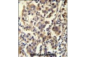 CCD Antibody (C-term) (ABIN655703 and ABIN2845154) immunohistochemistry analysis in formalin fixed and paraffin embedded human testis carcinoma followed by peroxidase conjugation of the secondary antibody and DAB staining. (CCDC110 抗体  (C-Term))