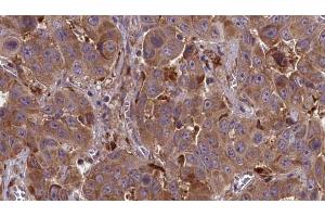 ABIN6273856 at 1/100 staining Human liver cancer tissue by IHC-P. (GPR148 抗体)