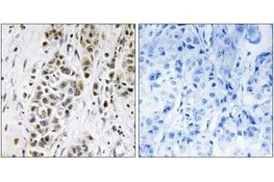 Immunohistochemistry analysis of paraffin-embedded human breast carcinoma tissue, using XRN2 Antibody. (Renin-2 抗体  (AA 81-130))
