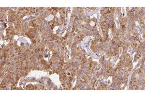 ABIN6267115 at 1/100 staining Human thyroid cancer tissue by IHC-P. (EIF4G1 抗体  (pSer1147))