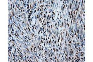 Immunohistochemical staining of paraffin-embedded Adenocarcinoma of ovary tissue using anti-HSPA1Amouse monoclonal antibody. (HSP70 1A 抗体)