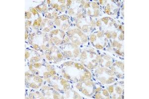 Immunohistochemistry of paraffin-embedded human stomach cancer using ANKRD52 antibody.