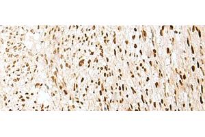 Immunohistochemistry of paraffin-embedded Human liver cancer tissue using PRPF3 Polyclonal Antibody at dilution of 1:35(x200) (PRPF3 抗体)