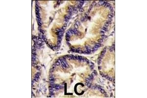 Formalin-fixed and paraffin-embedded human lung carcinoma tissue reacted with VEGF2 antibody (Center) (ABIN390259 and ABIN2837933) , which was peroxidase-conjugated to the secondary antibody, followed by DAB staining. (VEGFB (VEGF2) (AA 110-139) 抗体)