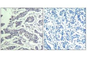 Immunohistochemical analysis of paraffin-embedded human breast carcinoma tissue using AKT1/AKT2/AKT3(Phospho-Tyr315/316/312) Antibody(left) or the same antibody preincubated with blocking peptide(right). (AKT 1/2/3 抗体  (pTyr312, pTyr315, pTyr316))