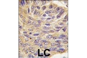 Formalin-fixed and paraffin-embedded human lung carcinoma tissue reacted with MEG2 antibody (C-term), which was peroxidase-conjugated to the secondary antibody, followed by DAB staining. (PTPN9 抗体  (C-Term))