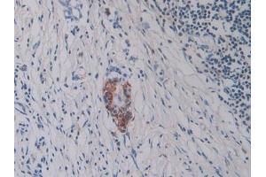 Detection of Hepc in Human Pancreatic cancer Tissue using Monoclonal Antibody to Hepcidin (Hepc) (Hepcidin 抗体  (AA 25-84))