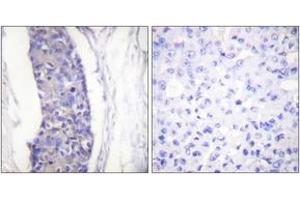 Immunohistochemistry analysis of paraffin-embedded human breast carcinoma tissue, using Tubulin alpha Antibody. (alpha Tubulin 抗体)