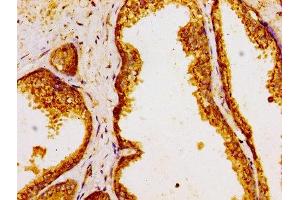 Immunohistochemistry of paraffin-embedded human prostate cancer using ABIN7154296 at dilution of 1:100 (GOLPH3 抗体  (AA 16-150))