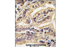 Formalin-fixed and paraffin-embedded human lung carcinoma tissue reacted with CSF1R polyclonal antibody  , which was peroxidase-conjugated to the secondary antibody, followed by DAB staining. (CSF1R 抗体  (C-Term))