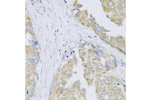 Immunohistochemistry of paraffin-embedded human liver cancer using ARFGAP3 antibody (ABIN5974520) at dilution of 1/100 (40x lens). (ARFGAP3 抗体)