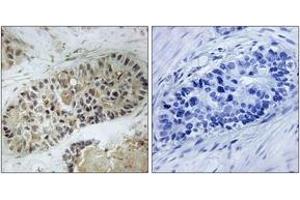 Immunohistochemistry analysis of paraffin-embedded human lung carcinoma, using Artemis (Phospho-Ser516) Antibody. (DCLRE1C 抗体  (pSer516))